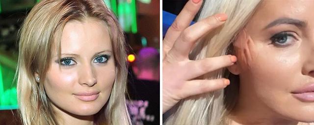 Дана Борисова продемонстрировала шрамы на лице после процедуры нитевого лифтинга