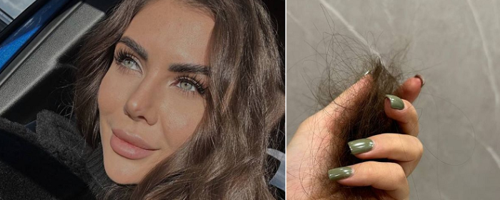 Блогер София Стужук показала клоки выпадающих волос